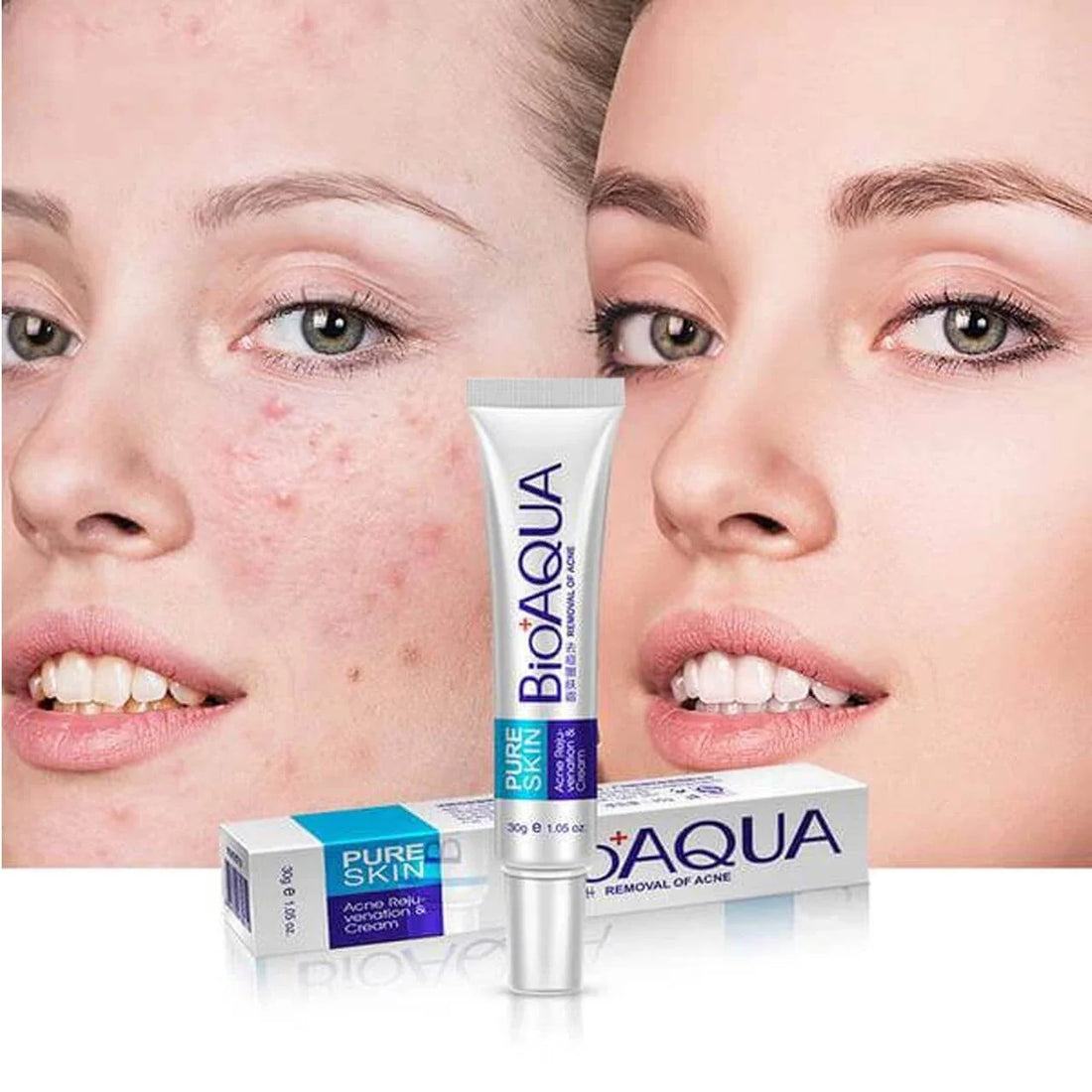 Bioaqua Acne Treatment Cream